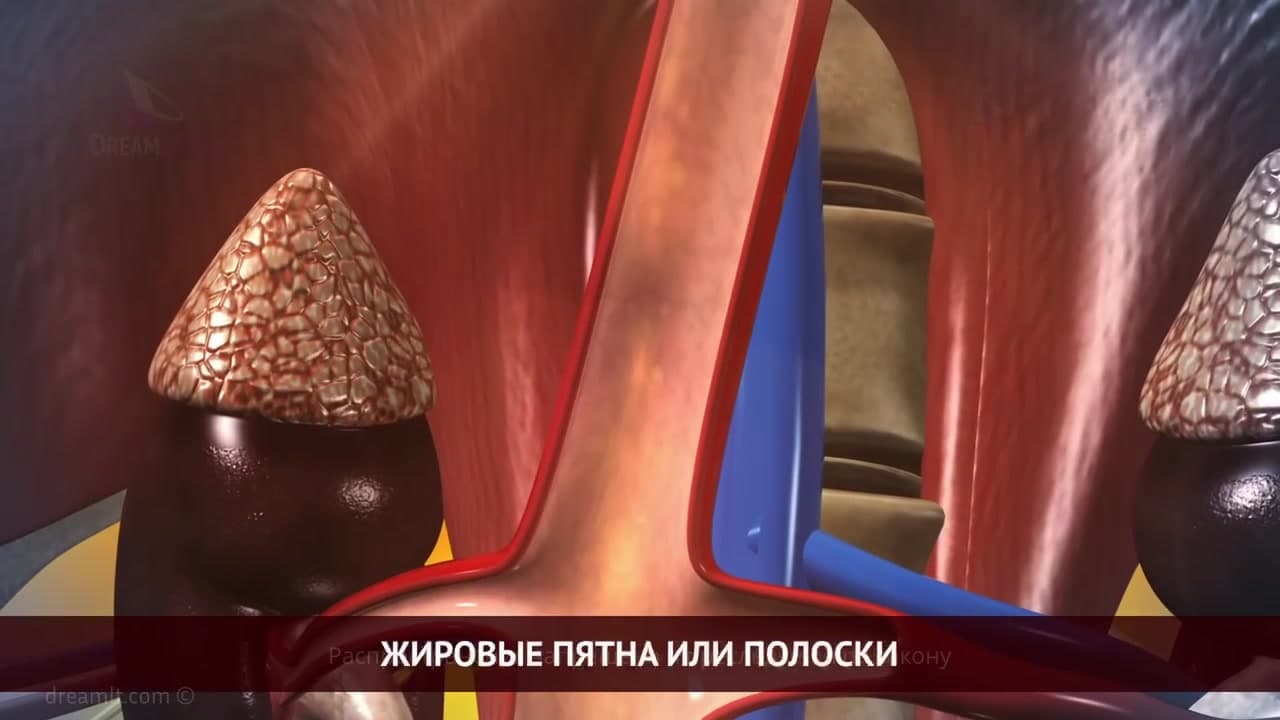 Atherosclerosis