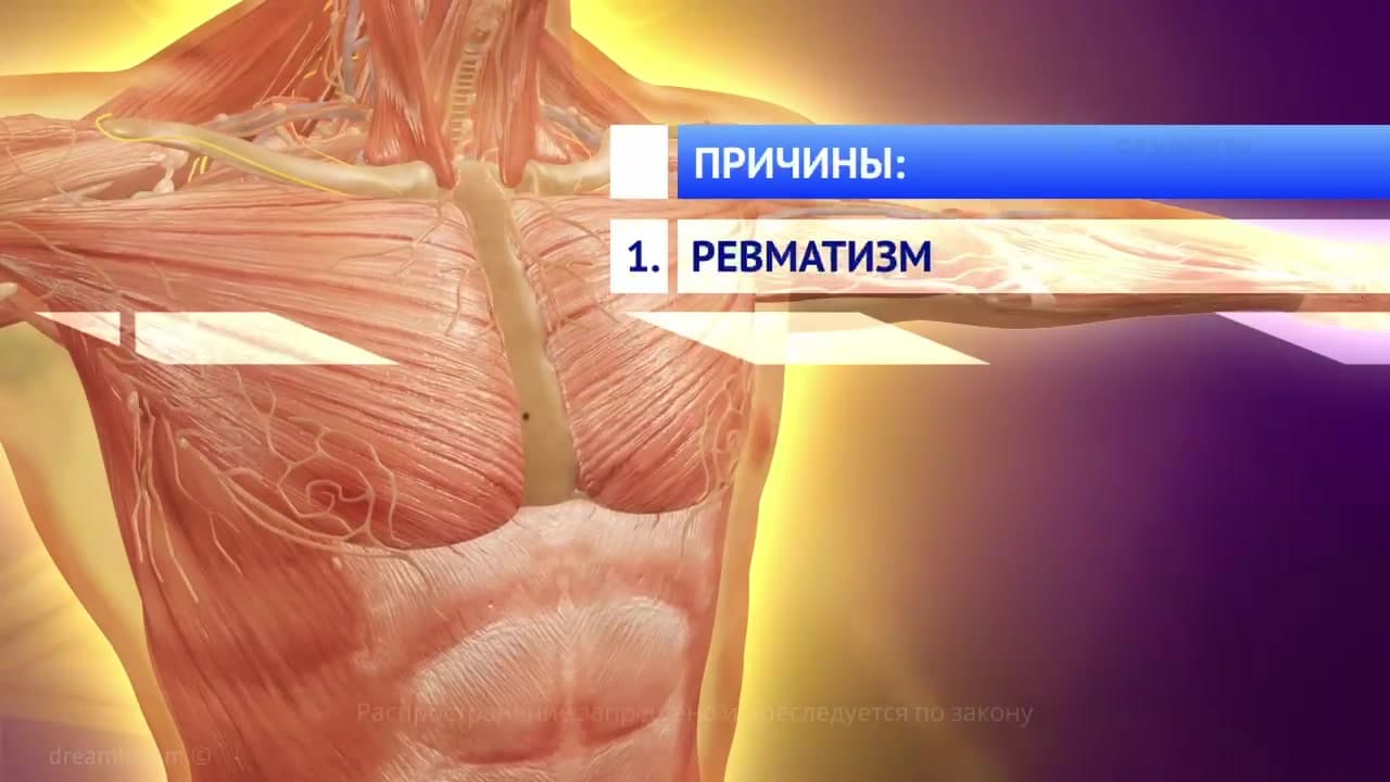 Valvular heart disease
