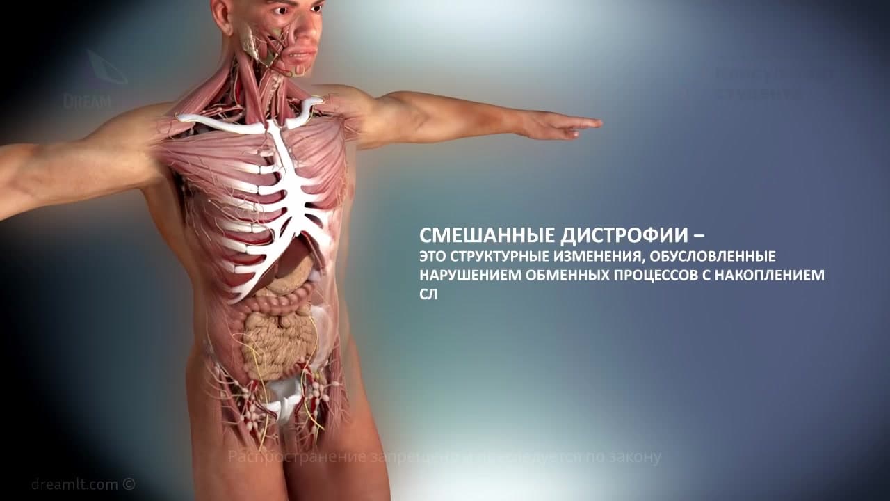 Mixed dystrophies