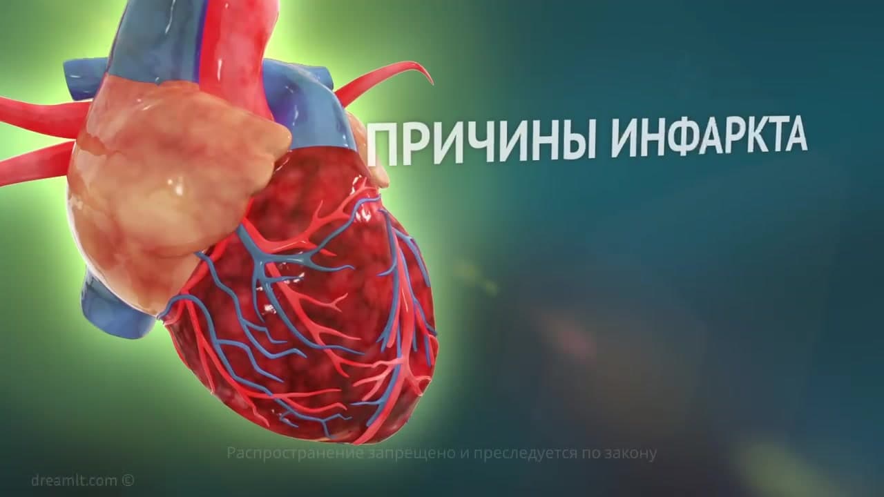 Myocardial infarction