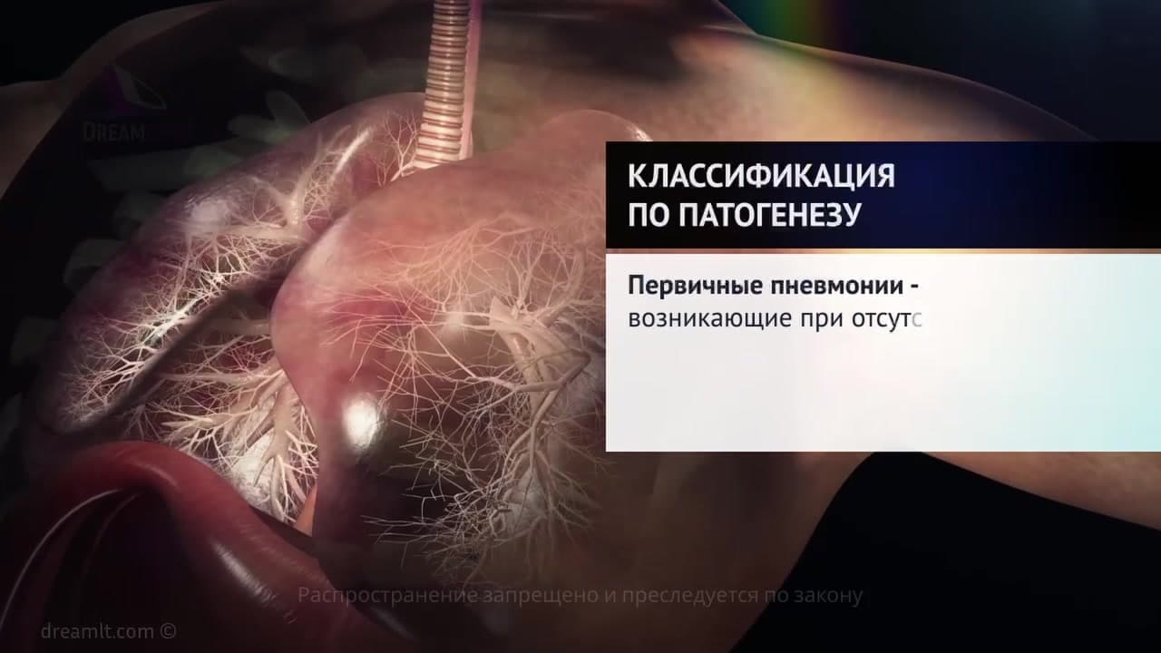Пневмонии